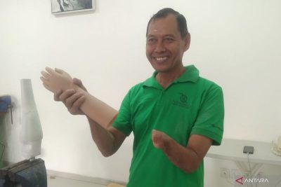 Yayasan Puspadi Bali Mulai Produksi Tangan Palsu untuk Penyandang Disabilitas